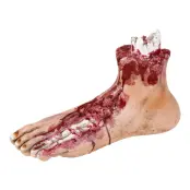 Avhuggen Fot med Köttsår