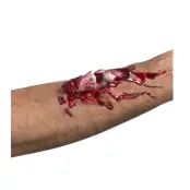 Brutet ben i köttigt sår