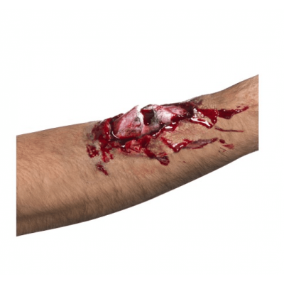 Brutet ben i köttigt sår