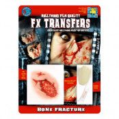 FX Transfers Bone Fracture 3D
