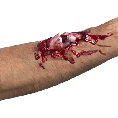 Öppen Benfraktur Latexsår